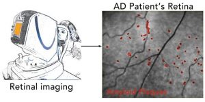 Alzheimer's disease eye scan