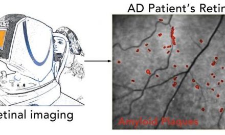 New Eye Test Can Detect Alzheimer’s Disease Many Years Prior to Symptoms Emerging